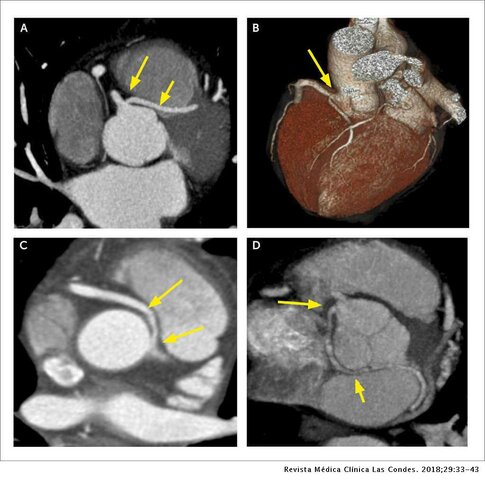 Tomografía por rayo de electrones EBCT