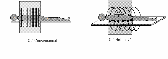 Tomografía en espiral