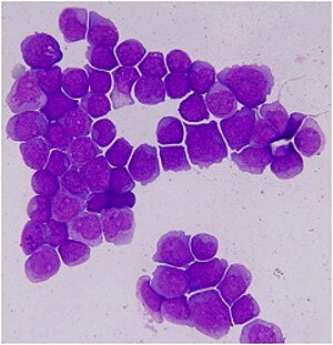 Secuencia de genoma del cancer