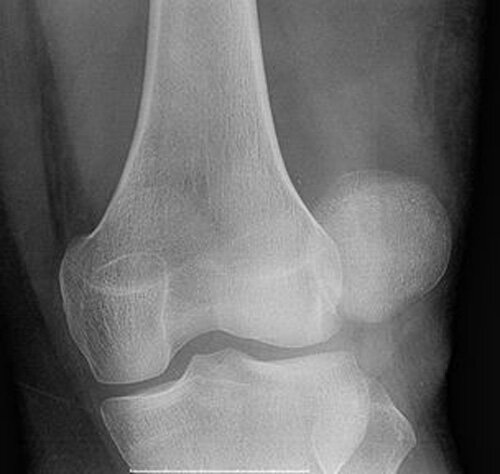 me lesionaron de la rodilla