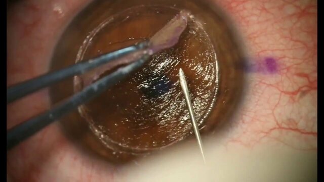 1era cirugía de trasplante en seres humanos