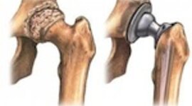 Timeline: Metal-on-Metal Hip Replacement/Resurfacing Studies