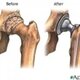 Hip replacement before and after diagram copy