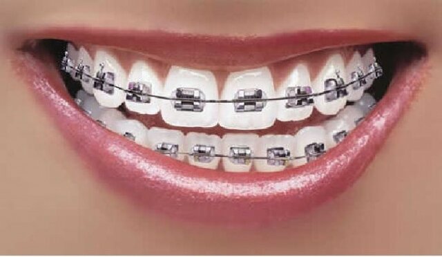 Em fiquen brakets