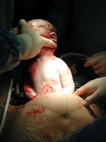 COMPLICACIONES AL MOMENTO DEL NACIEMIENTO