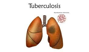 Vacuna contra la tuberculosis