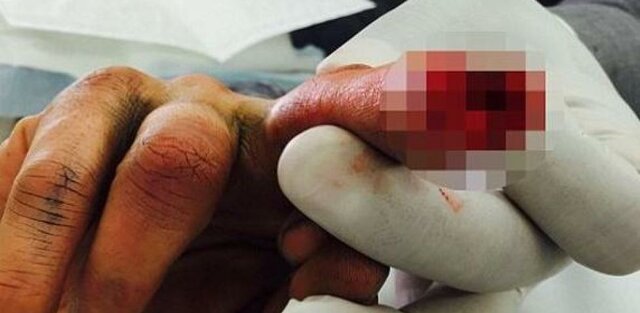 Amber cuts off his finger