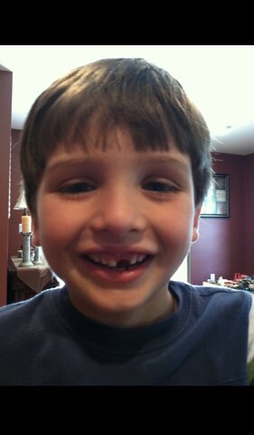 Lost front tooth