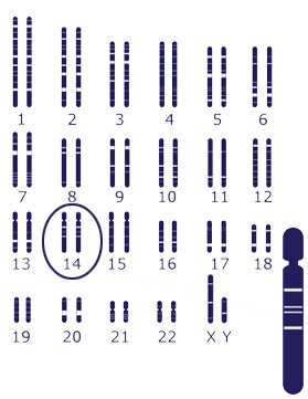 El primer gen determinista del Alzheimer es descubierto