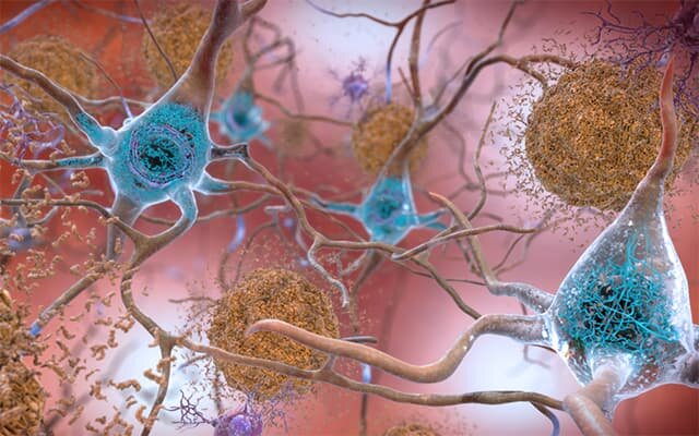 Se descubre un componente crucial de la enfermedad de Alzheimer