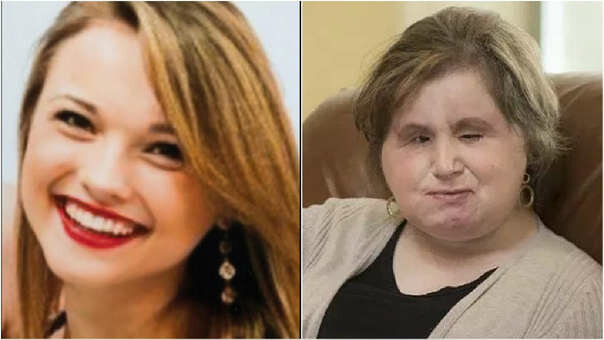 Trasplante de Rostro