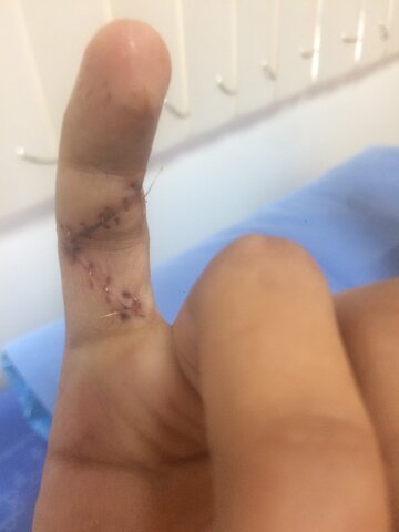 me lastime el dedo meñique