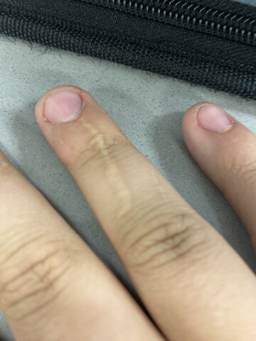 The Story of How I Got a Scar On My Right Ring Finger