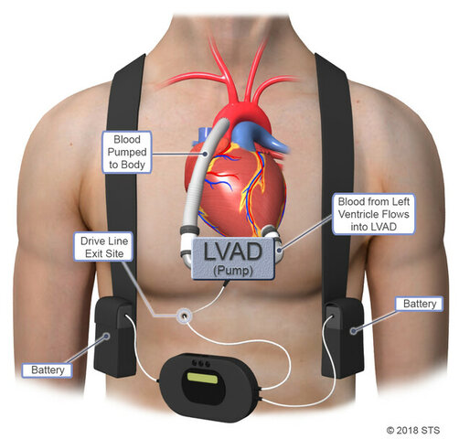 LVAD
