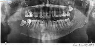 Empezó a declinar la salud de Freud, padecía cáncer en la boca y mandíbula
