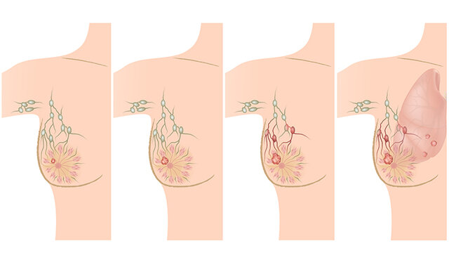 Descubrimiento de BRCA1 y BRCA2