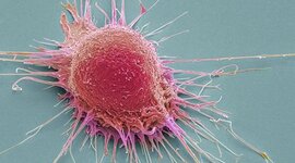 Timeline: Cancer Evolution