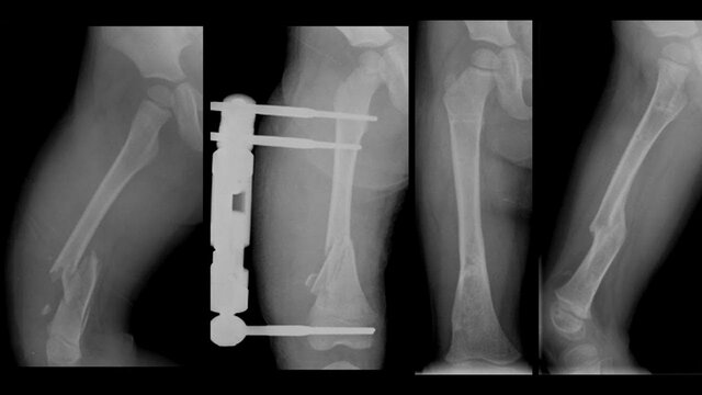 ACCIDENTE DE TRÀNSITO