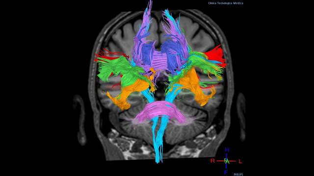 Neuroimagen por tensor de difusión.