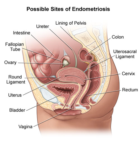 Me diagnosticaron endometriosis.