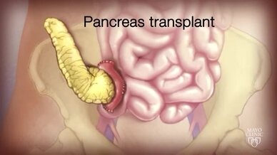 Primer trasplante de páncreas