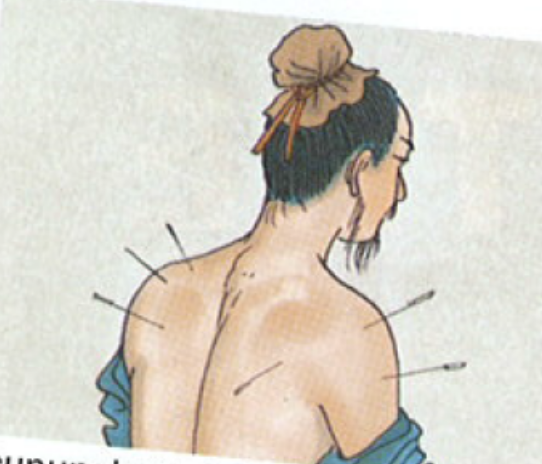 Acupuncture Statuette