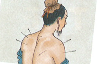 Acupuncture