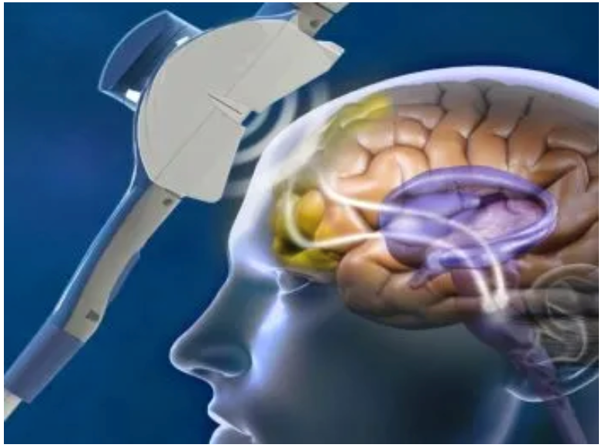 Estimulación magnética transcraneal