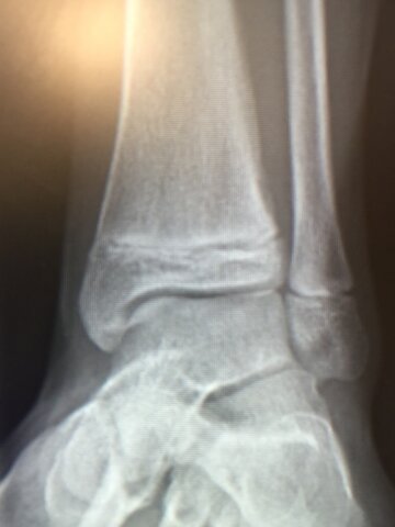 broken ankle