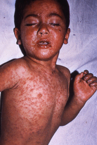 First vaccine for measles