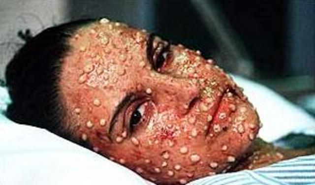 last fatal case of small pox