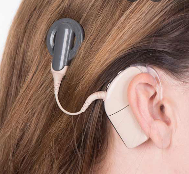 Cochlear Implant
