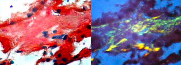 Desucbrimiento del fenómeno de birrefringencia en el amiloide teñido con Rojo Congo (Divry y Florkin)