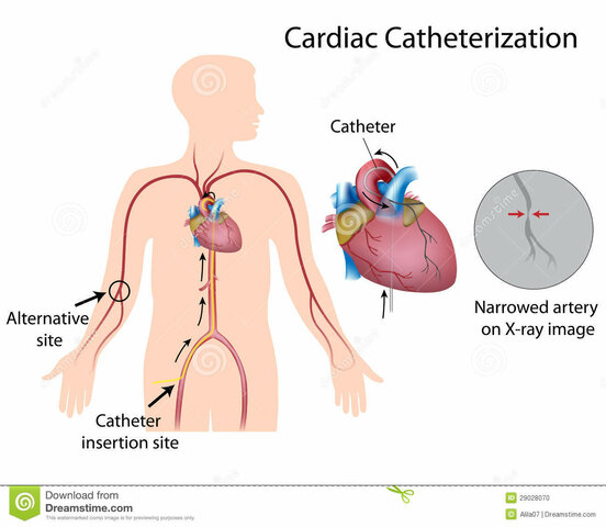 Cateterización del corazón