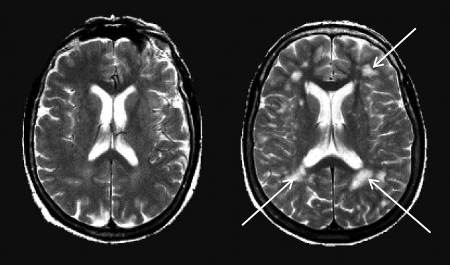 Cinquième âge du cerveau (65 ans et plus)