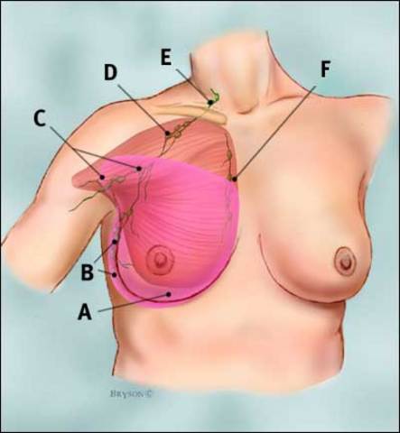 Mastectomy
