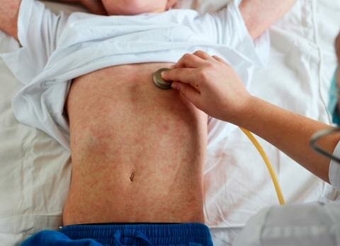 Último caso de Sarampión en México (En Teoría)