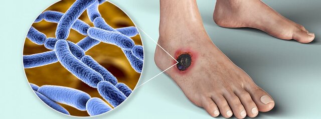 Bacillus anthracis (ántrax)