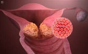 Hausen, Barré-Sinoussi y Montagnier