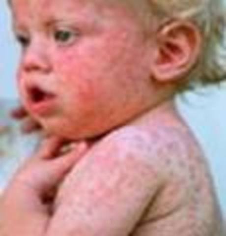 Measles