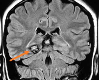 Se encuentra la lesión cerebral que provoca la epilepsia