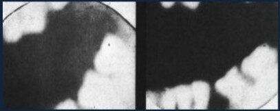 Primera radiografía dental