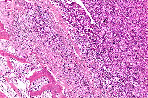 metastasis to osteosarcoma