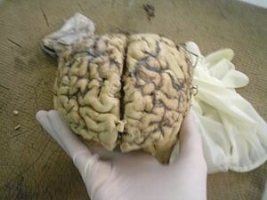 La patología del cerebro como causa