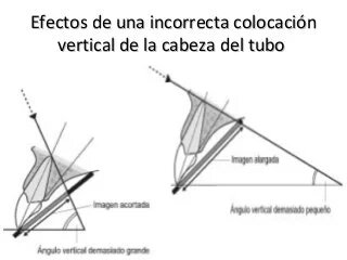 Técnica de bisectriz del angulo o cono corto