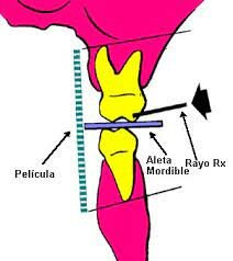 Técnica de aleta mordible
