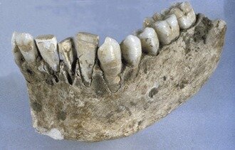 Implantes dentales