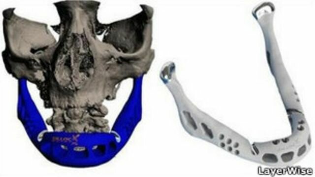 Trasplante de mandíbula impresa