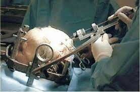 Ablación Experimental