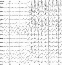 Electroencefalografía